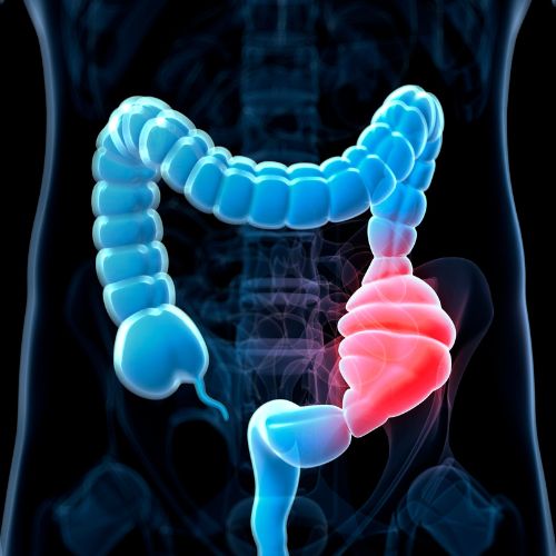 foods to avoid for constipation article